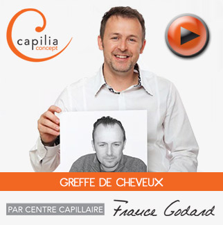 Greffe de cheveux – Centre capillaire France-Godard - St-Eustache