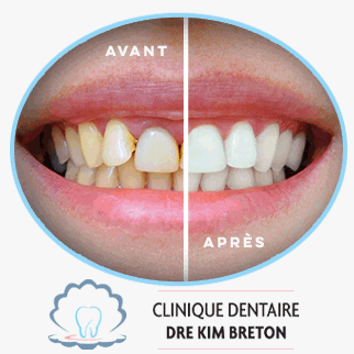 Blanchiment dentaire professionnel Mirabel - Clinique du Dre Kim Breton